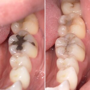 ダイレクトボンディングで修復 術前術後画像