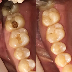 ダイレクトボンディング イメージ画像1