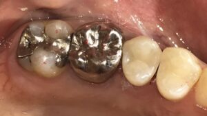 術後:ダイレクトボンディングで審美的に修復された画像