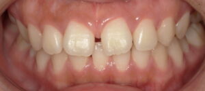 10代後半の女性 すきっぱ治療前