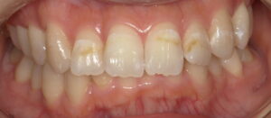 20代女性 変色した歯の画像 術前