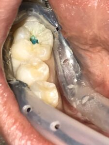 虫歯で歯が溶けている画像