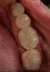 セラミック装着後