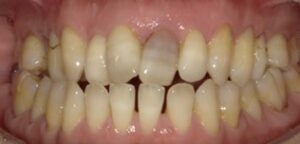 変色した歯-その1