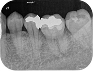 金歯のレントゲン写真