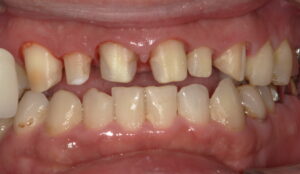 患者さん1:セラミック治療術前