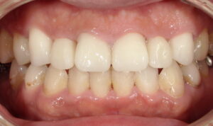 上顎右側犬歯~左側犬歯を若干白めにセラミックで治した症例