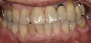 右下二番目の歯の変色画像-術前