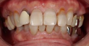 患者さん2:前歯治療術後