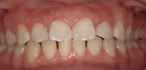 側切歯治療術後