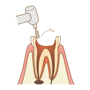 虫歯を取り除く画像