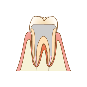 被せ物をした画像