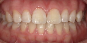 術後:すきっ歯がきれいに治った画像