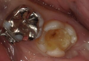 仮詰め及び虫歯を除去