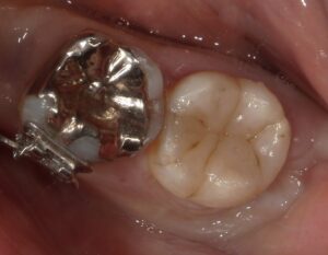 ダイレクトボンディングで修復