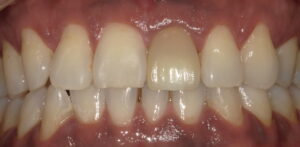 若干暗い色をしている1本の前歯