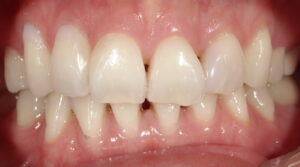 ブラックトライアングルが認められる歯の画像