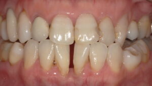 術前:下顎前歯に隙間がある画像