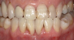 術後:隙間がなくなった画像