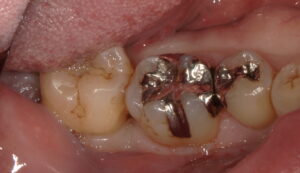 術前:右下5番目と6番目の銀歯の画像