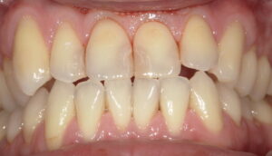 術前:上顎中切歯の間に古いCR充填の画像