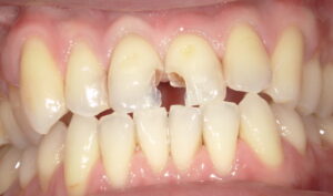 術中:古いCRおよび虫歯を除去した画像