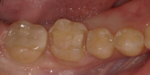 術中：セラミックを除去した画像