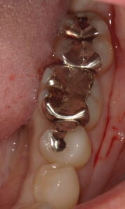 術前:左下5,6,7番目に銀歯