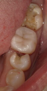 虫歯や古い接着剤を除去した後