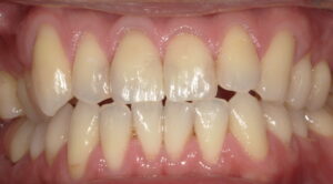 術後:詰め物の色が少し浮いて、歯と詰め物の境目がわかってしまう