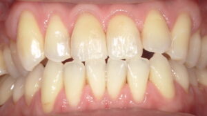 再充填後:境目はわからなくなり、自然な仕上がり