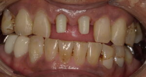 仮歯が外れた状態の画像