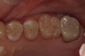 イレクトボンディングで修復した画像