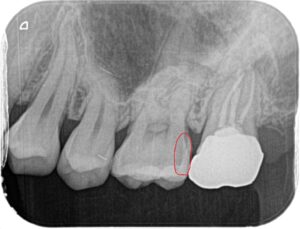 虫歯の箇所を指摘したレントゲン画像