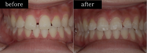 ダイレクトボンディング